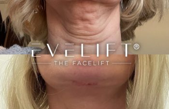 female patient before and after EVELift®