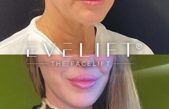 female patient before and after EVELift®