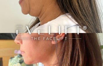 female patient before and after EVELift®