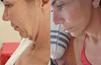 female patient before and after EVELift®
