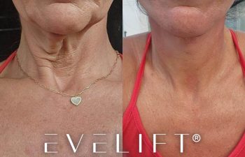 female patient before and after EVELift®