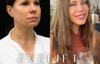 female patient before and after EVELift®