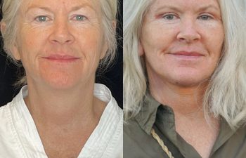 female patient before and after EVELift®