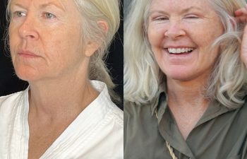 female patient before and after EVELift®