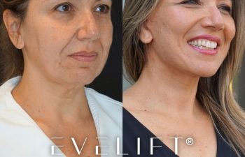 female patient before and after EVELift®