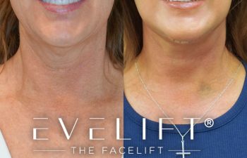 female patient before and after EVELift®