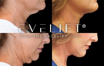 female patient before and after EVELift®