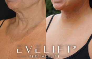 female patient before and after EVELift®