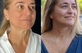 female patient before and after EVELift®