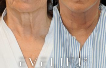 female patient before and after EVELift®