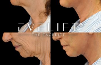 female patient before and after EVELift®