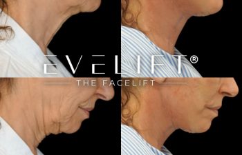 female patient before and after EVELift®