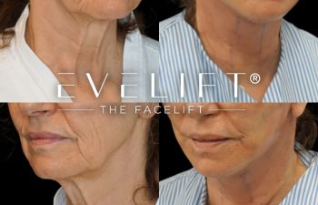 female patient before and after EVELift®