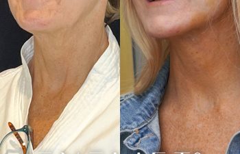 female patient before and after EVELift®