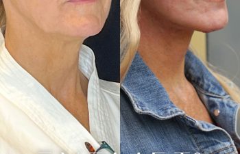 female patient before and after EVELift®