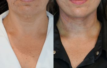 female patient before and after EVELift®