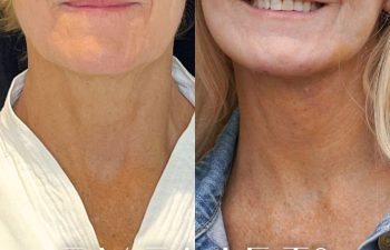 female patient before and after EVELift®