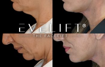 female patient before and after EVELift®