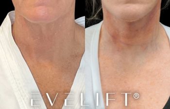 female patient before and after EVELift®