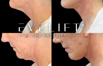 female patient before and after EVELift®