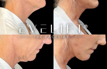 female patient before and after EVELift®