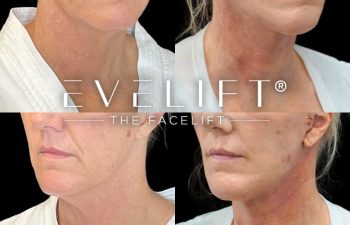 female patient before and after EVELift®