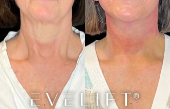 female patient before and after EVELift®