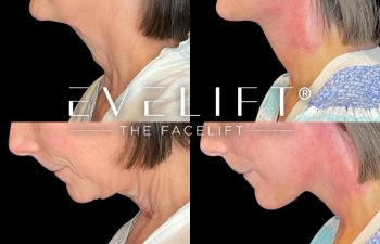 female patient before and after EVELift®