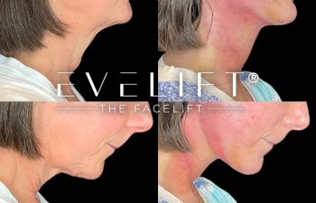 female patient before and after EVELift®