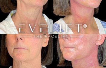female patient before and after EVELift®