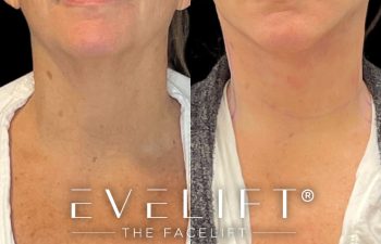 female patient before and after EVELift®