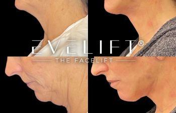 female patient before and after EVELift®