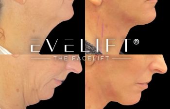 female patient before and after EVELift®