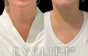 female patient before and after EVELift®