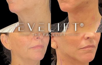 female patient before and after EVELift®