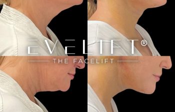 female patient before and after EVELift®
