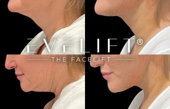 female patient before and after EVELift®