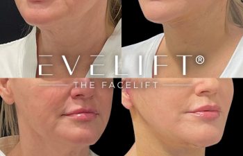 female patient before and after EVELift®