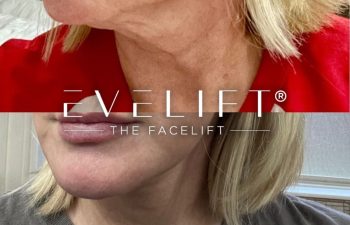 female patient before and after EVELift®