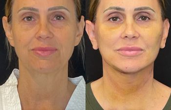 female patient before and after EVELift®