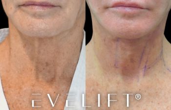 female patient before and after EVELift®