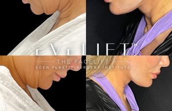 female patient before and after EVELift®