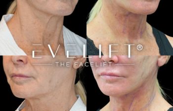 female patient before and after EVELift®