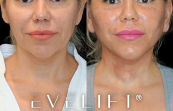female patient before and after EVELift®