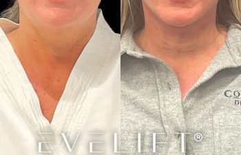 female patient before and after EVELift®
