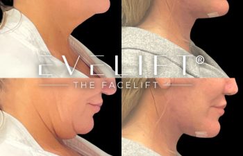 female patient before and after EVELift®