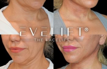 female patient before and after EVELift®