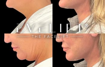 female patient before and after EVELift®