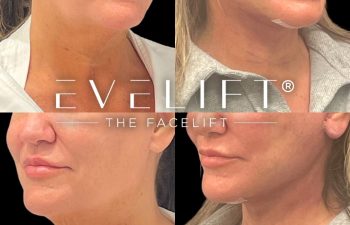 female patient before and after EVELift®
