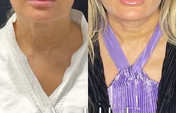 female patient before and after EVELift®